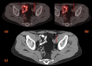 απεικόνιση με 18F-PSMA PET-CT abc
